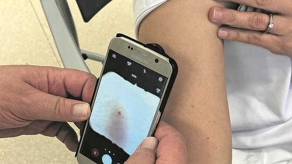 Teledermatologia aplicada a 3.000 pacients de la comarca